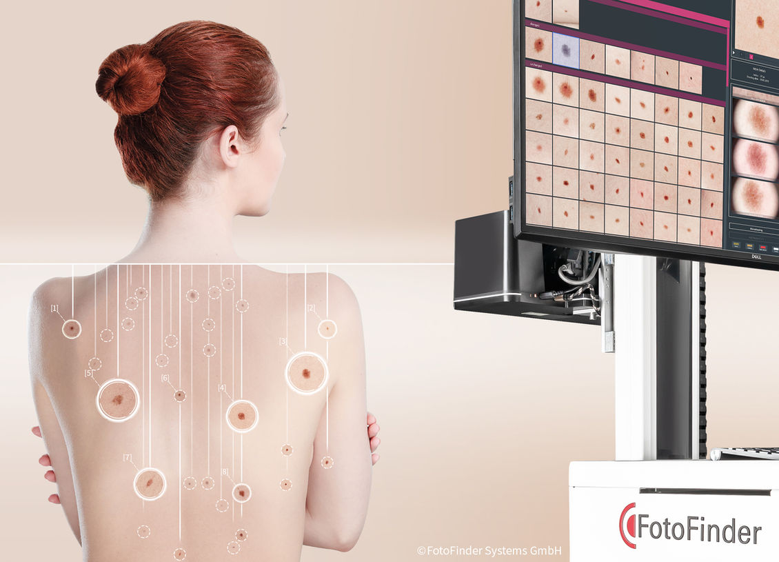 FotoFinder digital mole mapping system at MoleSpot